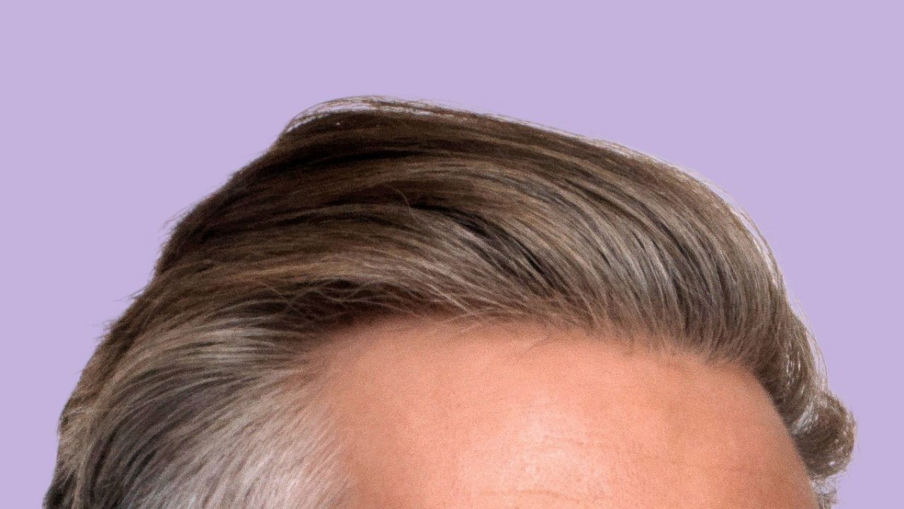 How much does a hair transplant cost? - MedExpress