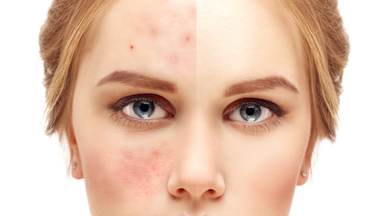 Suffering From Acne? 5 Ways to Survive A Bad Skin Day