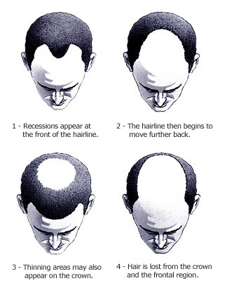 Male Pattern Hair Loss