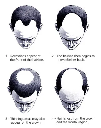 Male Pattern Hair Loss